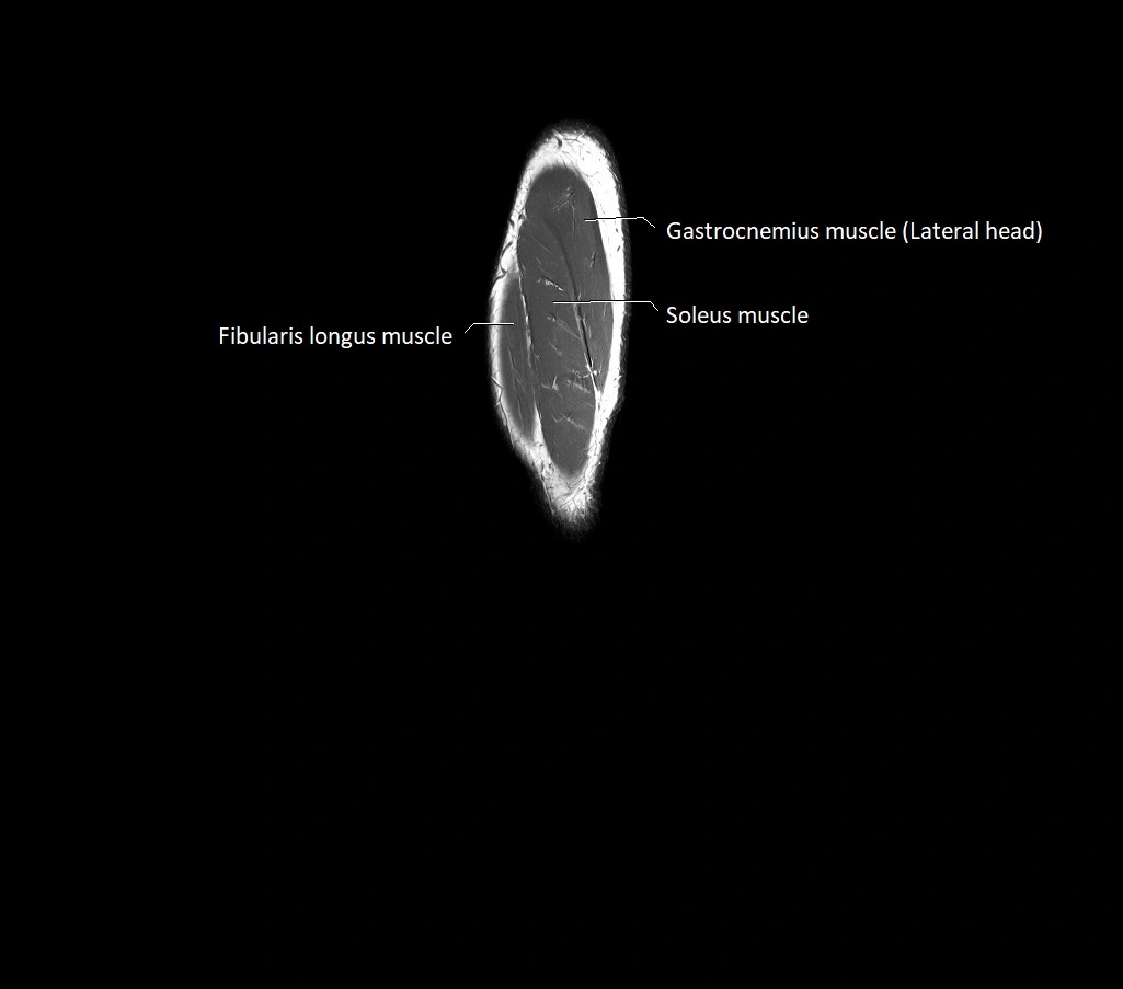 Lower leg sagittal anatomy 3T MRI image 1.webp